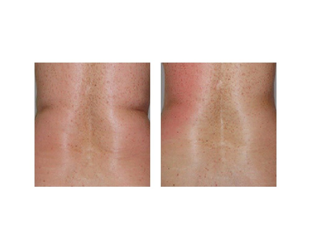 body contouring, 2 sessions