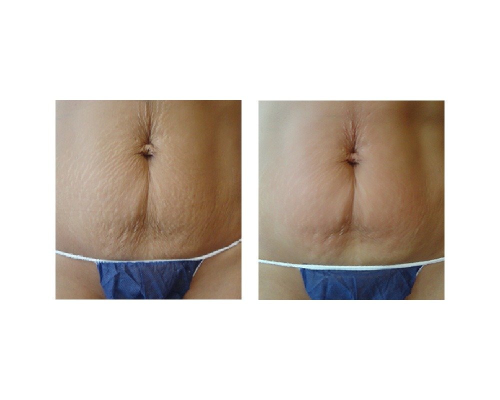 strech mark removal
